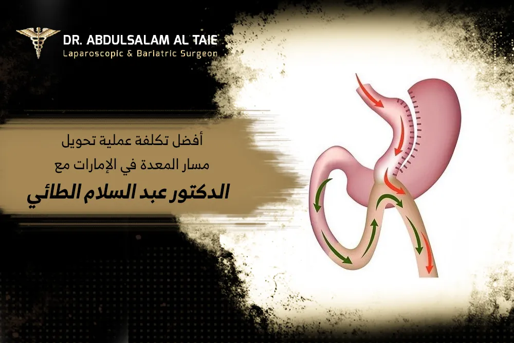 أفضل تكلفة عملية تحويل مسار المعدة في الإمارات مع دكتور عبد السلام الطائي