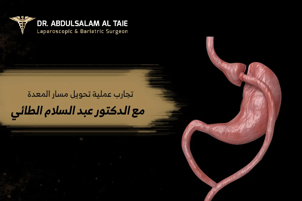 تجربتي مع تحويل مسار المعدة