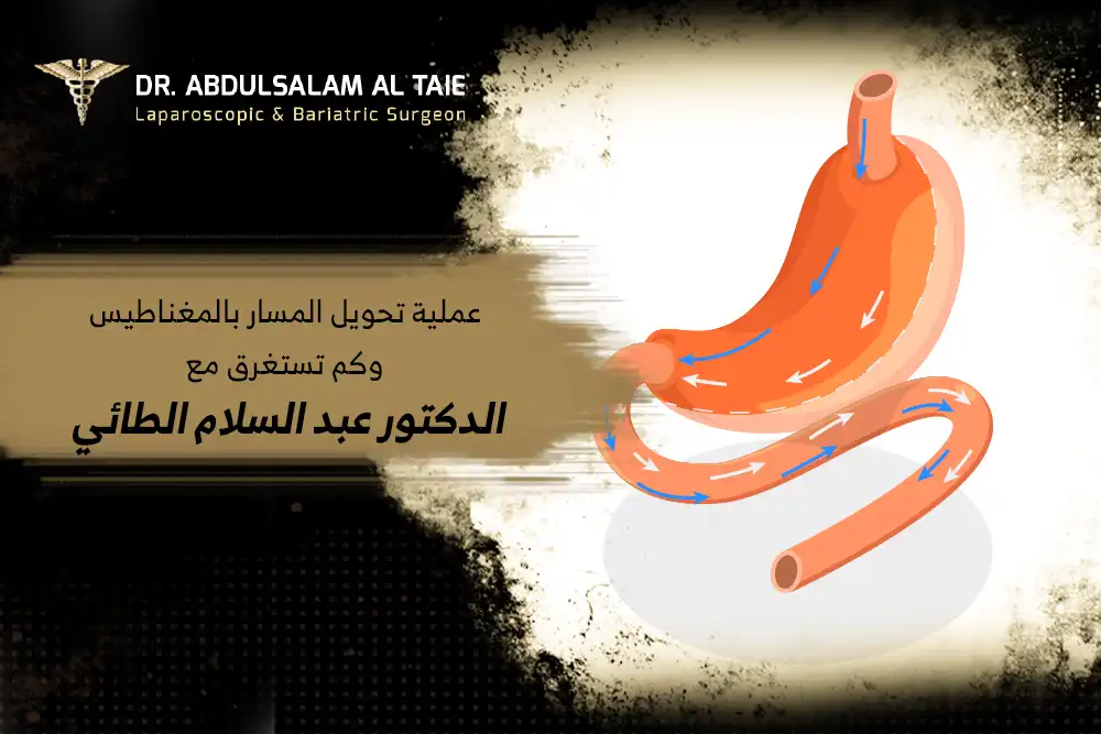 عملية تحويل مسار المعدة في الامارات