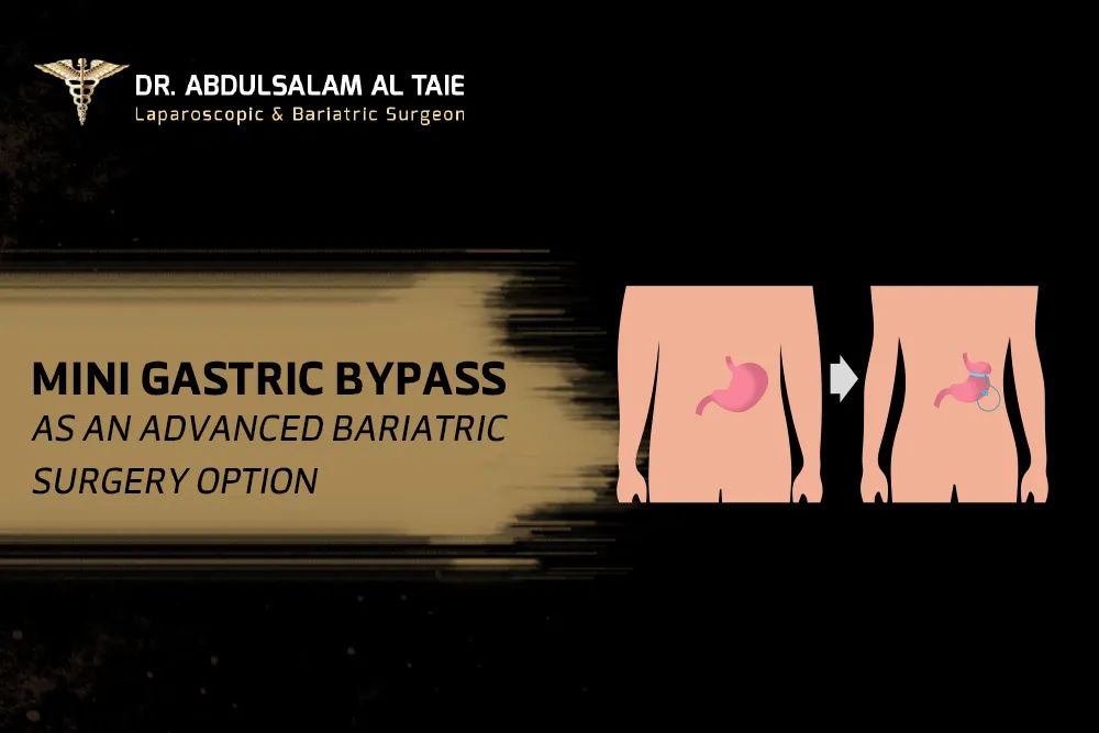 mini gastric bypass mini gastric bypass