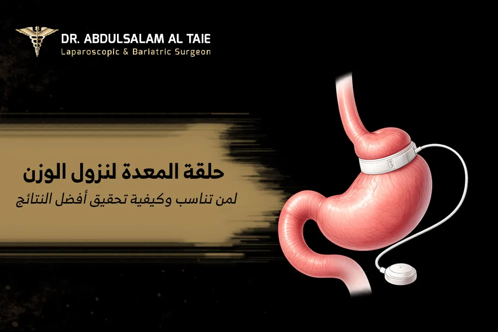 حلقة المعدة لنزول الوزن