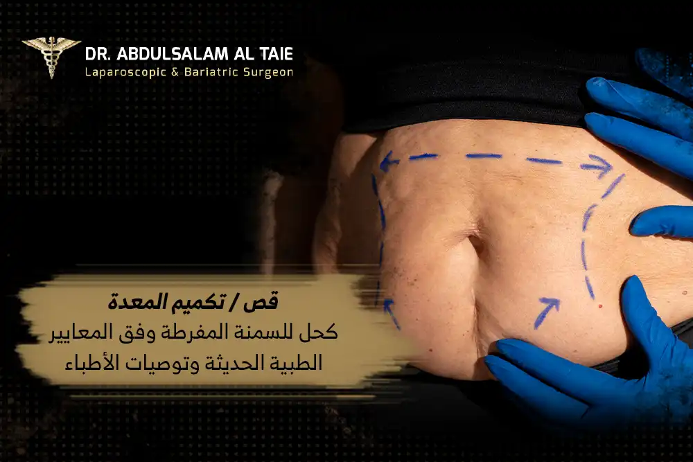 قص المعدة كحل للسمنة المفرطة