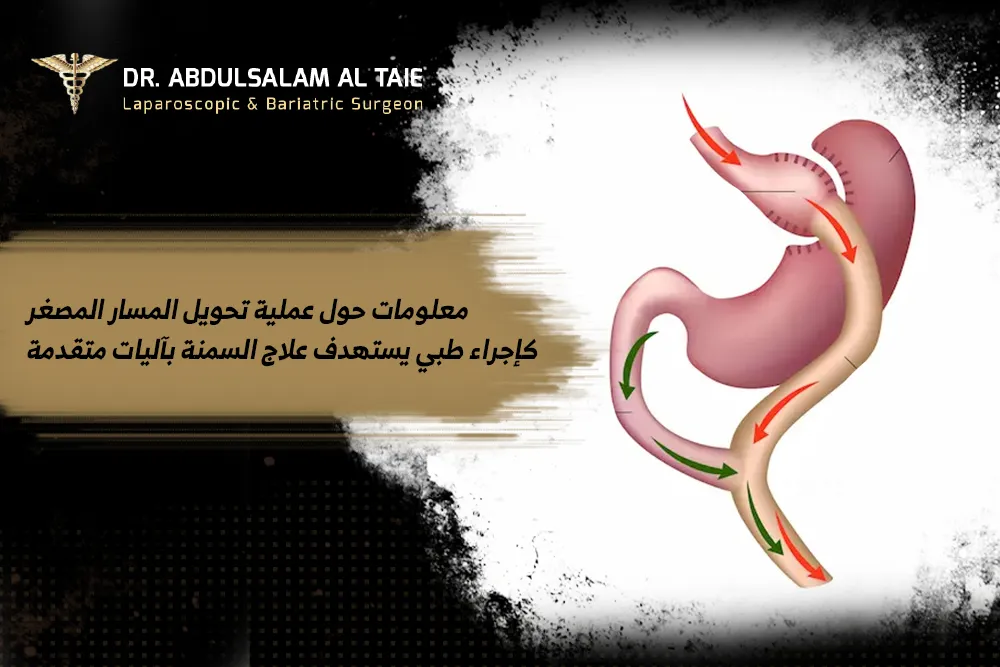 معلومات_حول_عملية_تحويل_المسار_المصغر_كإجراء_طبي_يستهدف_علاج_السمنة