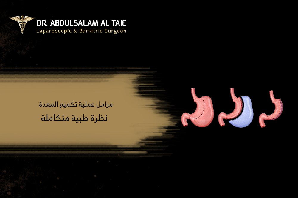 مراحل عملية تكميم المعدة